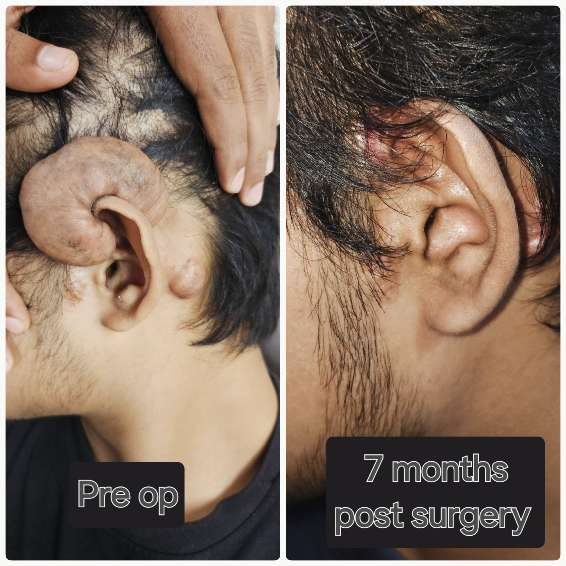 Ear reconstruction — Pre op & 7 months post surgery