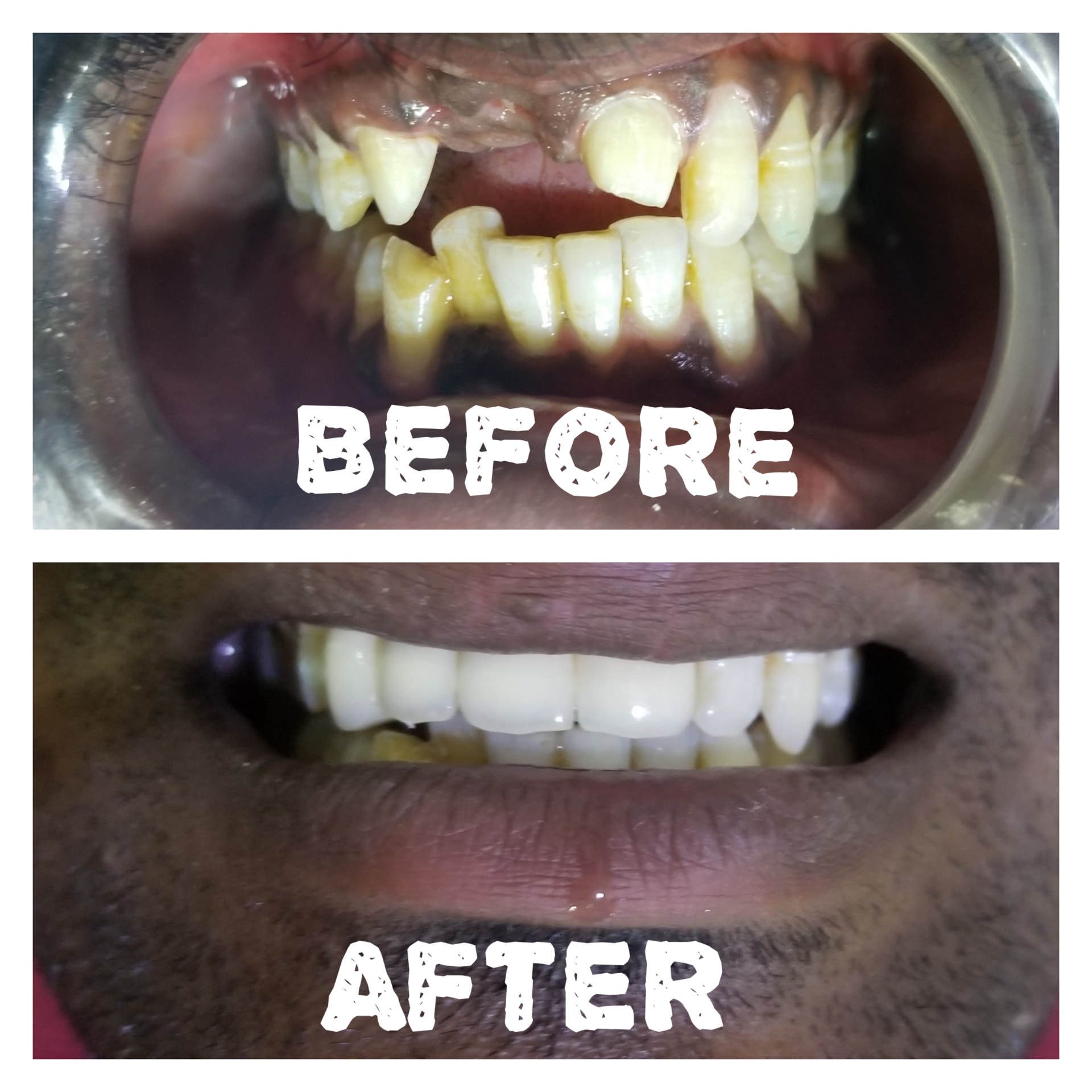 Full mouth rehabilitation — Before & after
