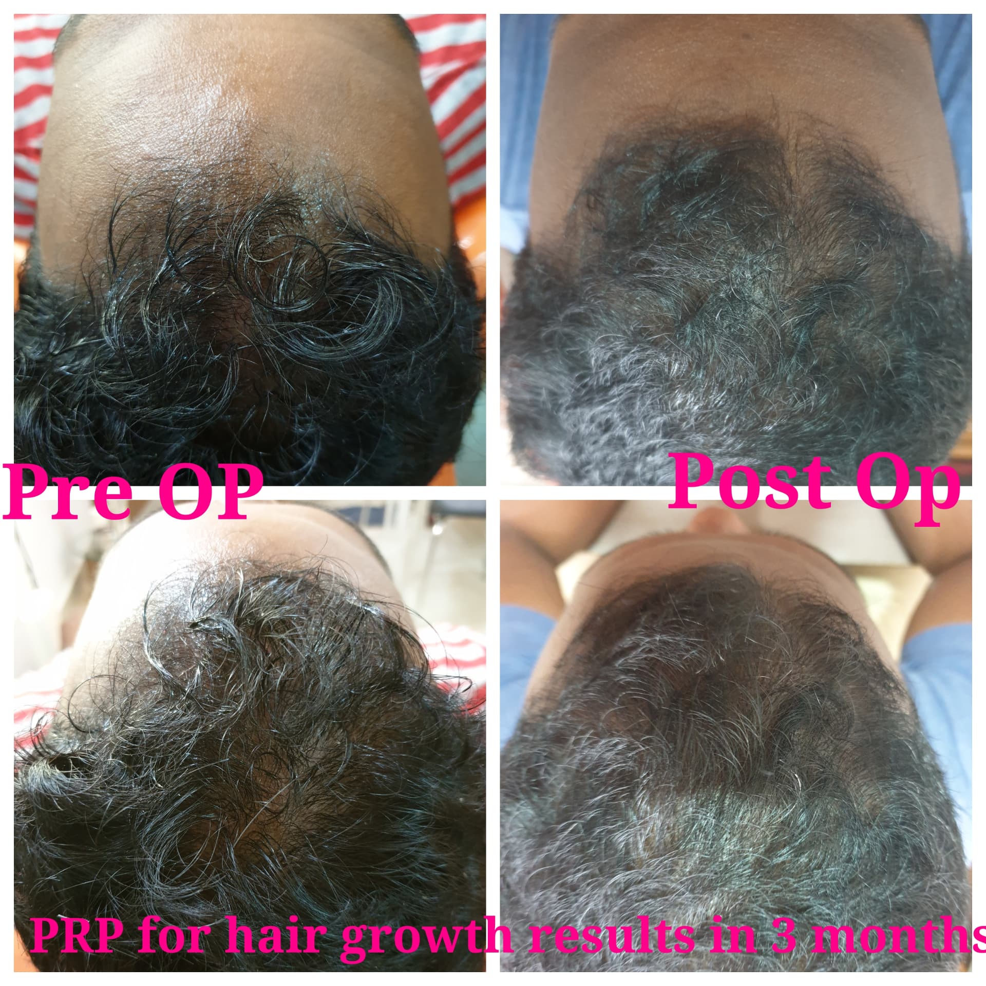 PRP for hair growth — Results in 3 months